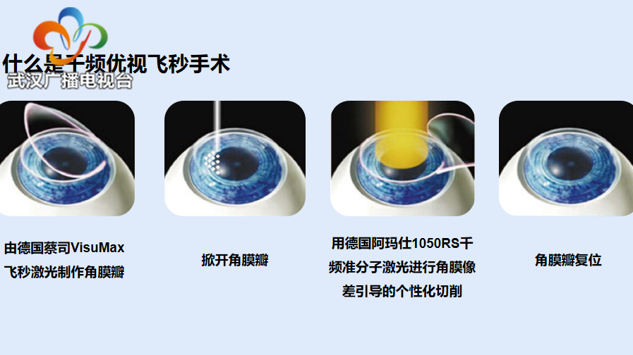 最新近视眼手术方式引领视力矫正新时代革命